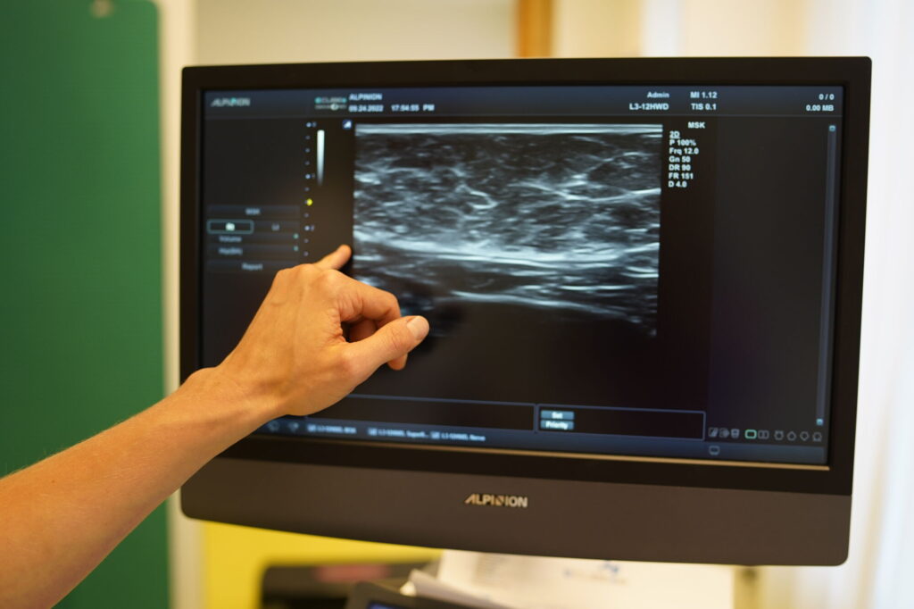 ultrazvuk rozestupu přímých břišních svalů